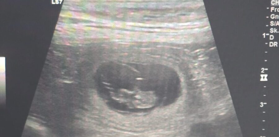 Ultraschall Termin für den D-Wurf